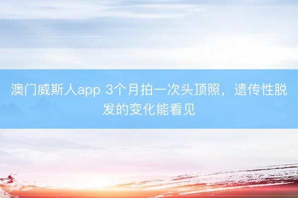 澳门威斯人app 3个月拍一次头顶照，遗传性脱发的变化能看见